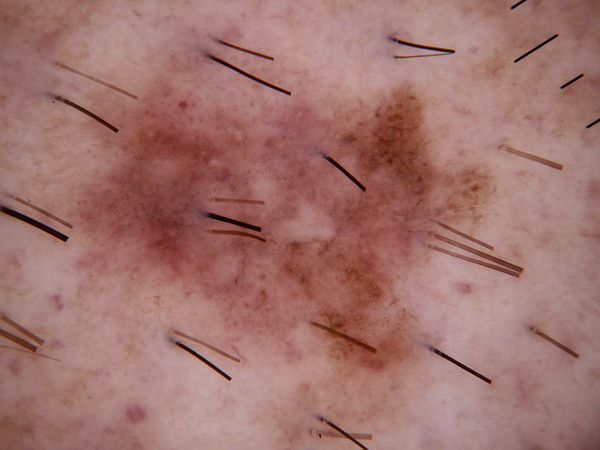 Good quality lesion image example
