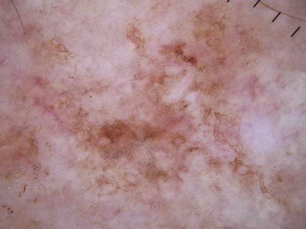 Good quality lesion image example