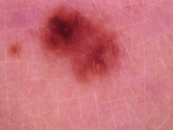 Good quality lesion image example