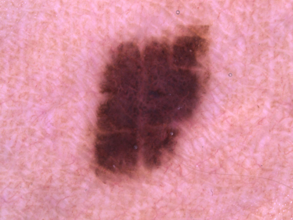 Good quality lesion image example