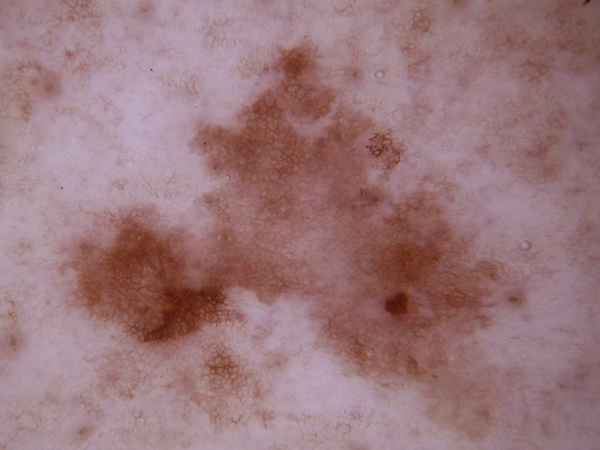 Good quality lesion image example